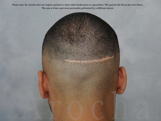 FUE Hair Restoration: Case 4 - Before