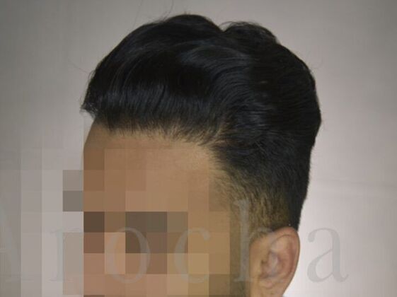 FUE Hair Restoration: Case 4 - After