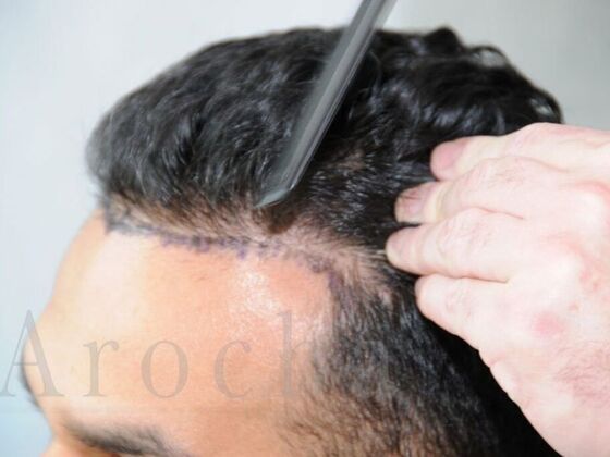 FUE Hair Restoration: Case 4 - Before