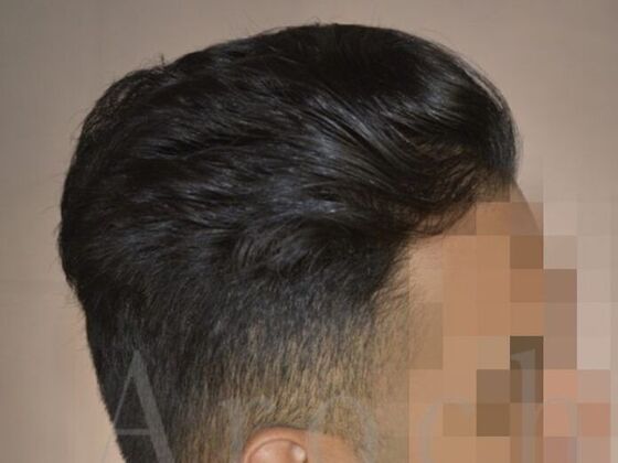 FUE Hair Restoration: Case 4 - After