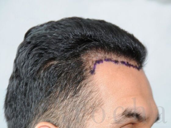 FUE Hair Restoration: Case 4 - Before