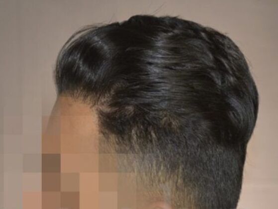 FUE Hair Restoration: Case 4 - After
