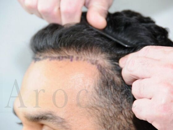 FUE Hair Restoration: Case 4 - Before