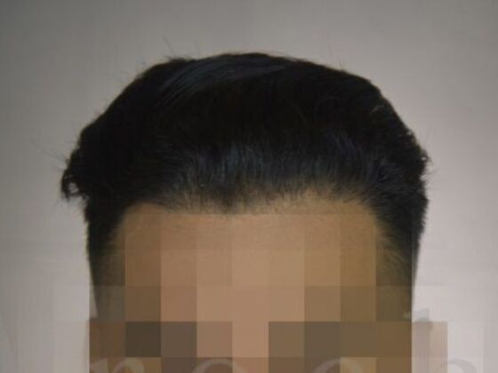 FUE Hair Restoration: Case 4 - After