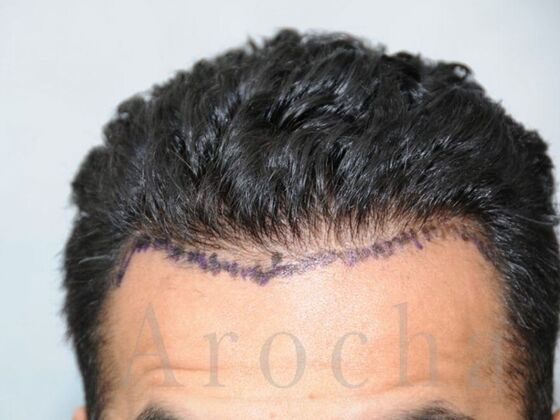 FUE Hair Restoration: Case 4 - Before