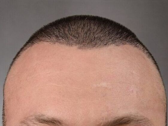 FUE Hair Restoration: Case 5 - After