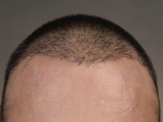 FUE Hair Restoration: Case 5 - Before