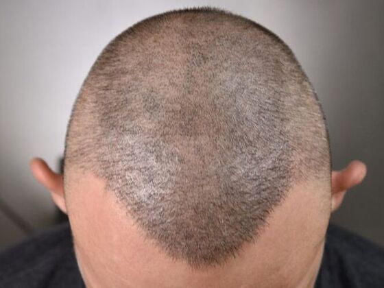 FUE Hair Restoration: Case 5 - After