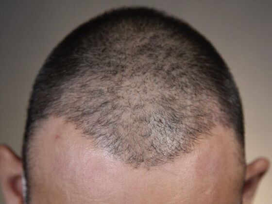 FUE Hair Restoration: Case 5 - Before