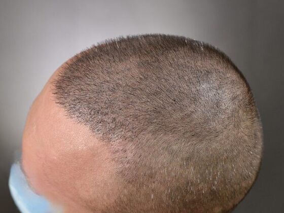 FUE Hair Restoration: Case 5 - After
