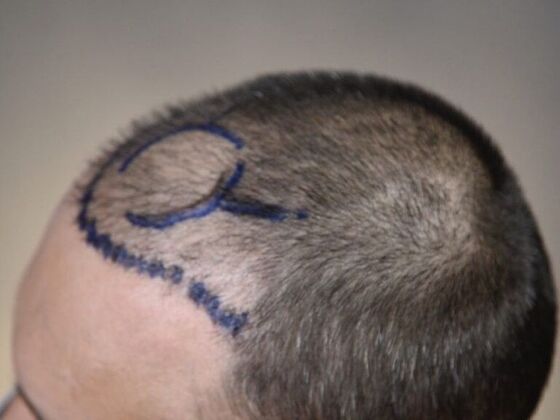 FUE Hair Restoration: Case 5 - Before