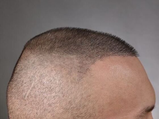 FUE Hair Restoration: Case 5 - After