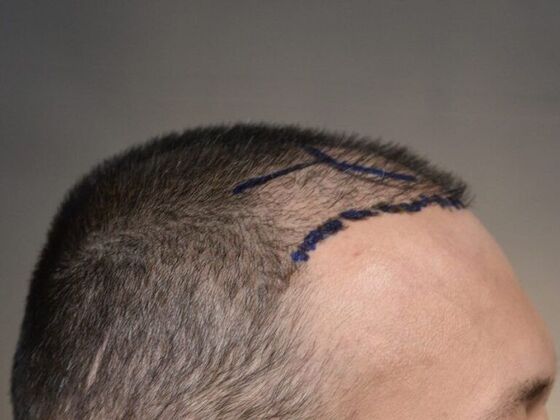 FUE Hair Restoration: Case 5 - Before