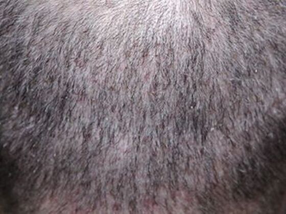 FUE Hair Restoration: Case 6 - After