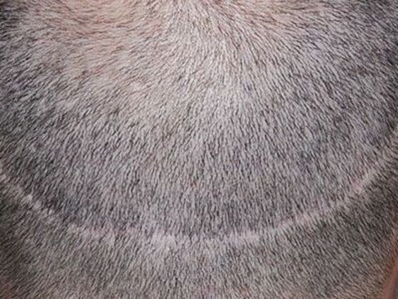 FUE Hair Restoration: Case 6 - Before