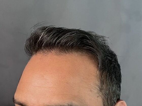 FUE Hair Restoration: Case 7 - After