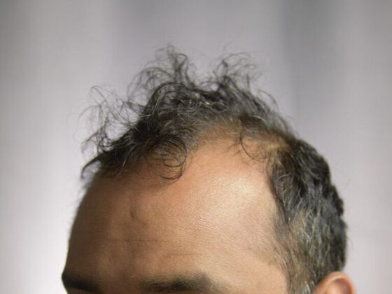 FUE Hair Restoration: Case 7 - Before