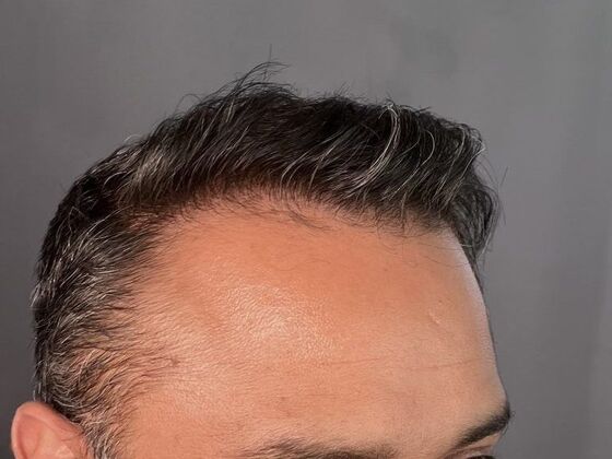 FUE Hair Restoration: Case 7 - After