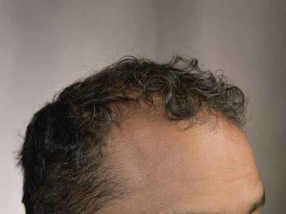 FUE Hair Restoration: Case 7 - Before