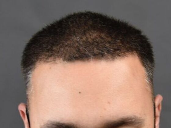 FUE Hair Restoration: Case 8 - After