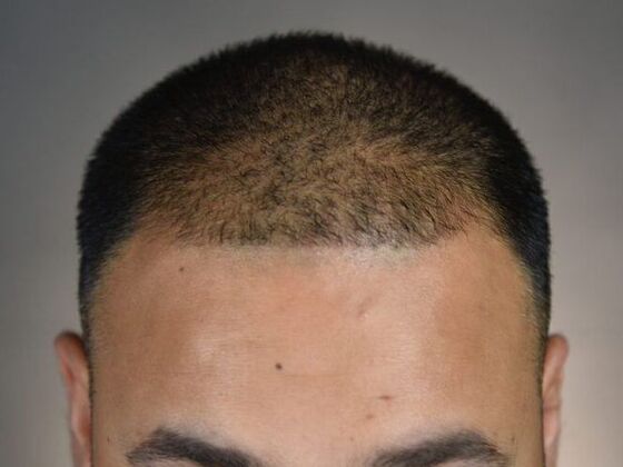FUE Hair Restoration: Case 8 - Before