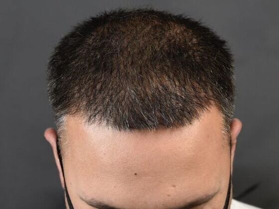 FUE Hair Restoration: Case 8 - After