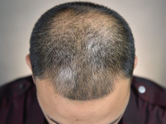 FUE Hair Restoration: Case 8 - Before