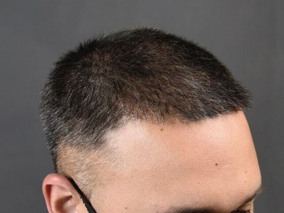 FUE Hair Restoration: Case 8 - After