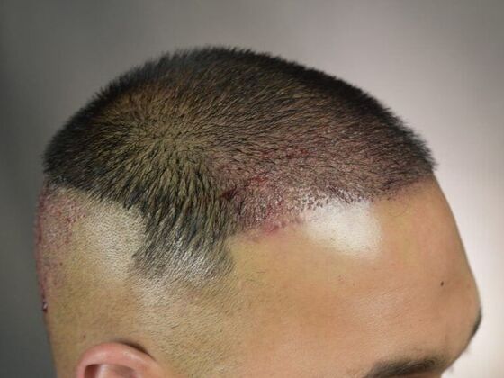 FUE Hair Restoration: Case 8 - Before