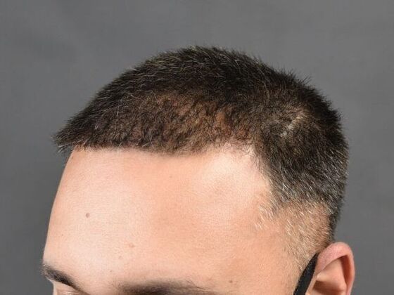 FUE Hair Restoration: Case 8 - After