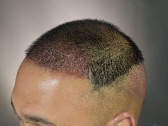 FUE Hair Restoration: Case 8 - Before