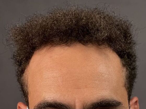 FUE Hair Restoration: Case 9 - After