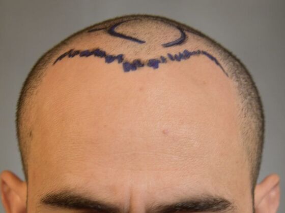 FUE Hair Restoration: Case 9 - Before