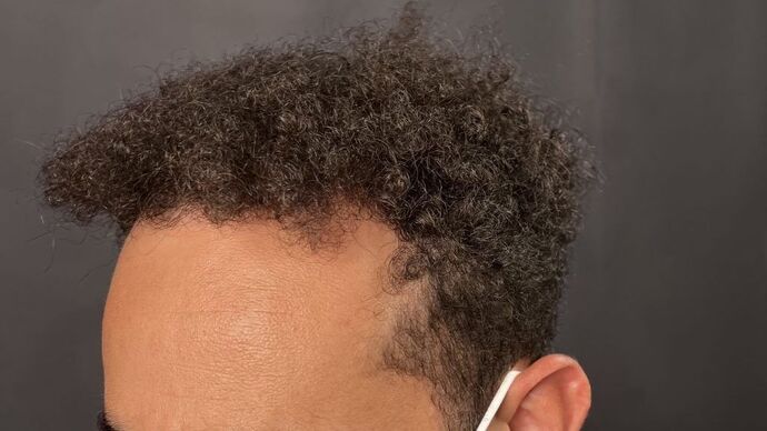 FUE Hair Restoration: Case 9 - After