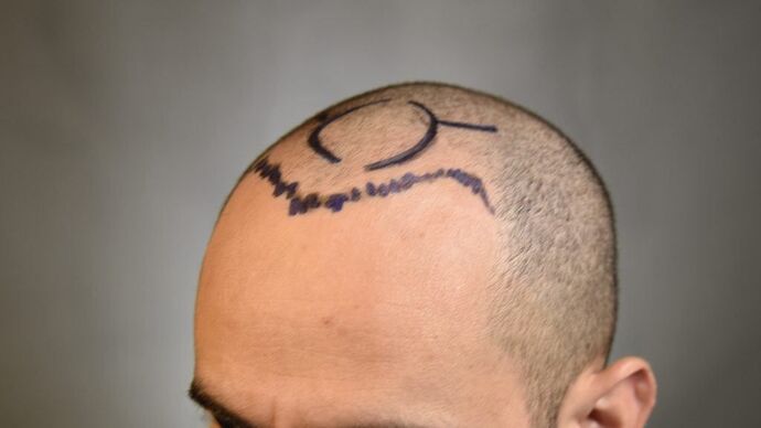 FUE Hair Restoration: Case 9 - Before