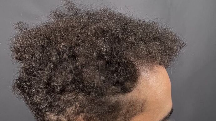 FUE Hair Restoration: Case 9 - After