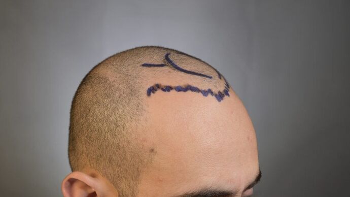 FUE Hair Restoration: Case 9 - Before