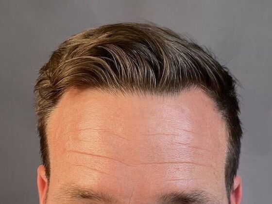 FUE Hair Restoration: Case 10 - After