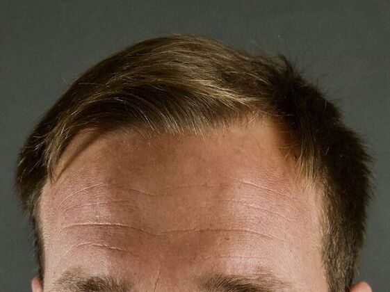 FUE Hair Restoration: Case 10 - Before