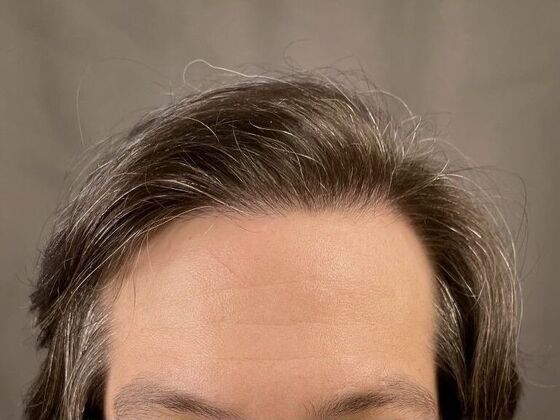 FUE Hair Restoration: Case 11 - After