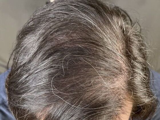 FUE Hair Restoration: Case 11 - After