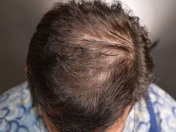 FUE Hair Restoration: Case 11 - Before