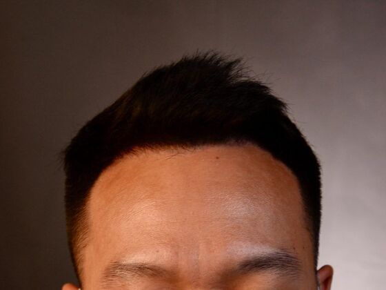 FUE Hair Restoration: Case 12 - After