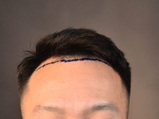 FUE Hair Restoration: Case 12 - Before