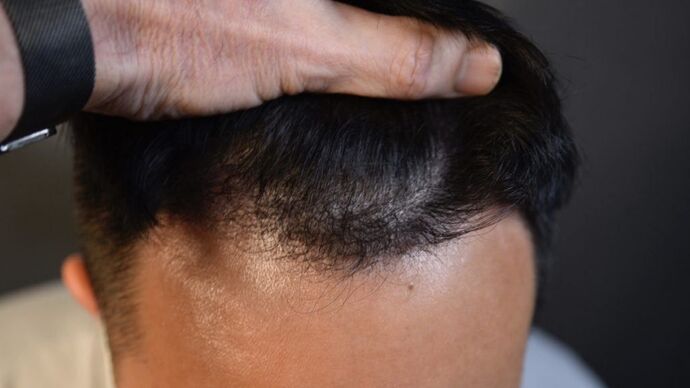 FUE Hair Restoration: Case 12 - After