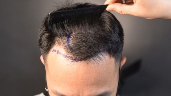 FUE Hair Restoration: Case 12 - Before