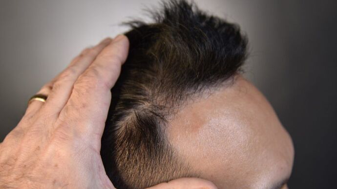 FUE Hair Restoration: Case 12 - After