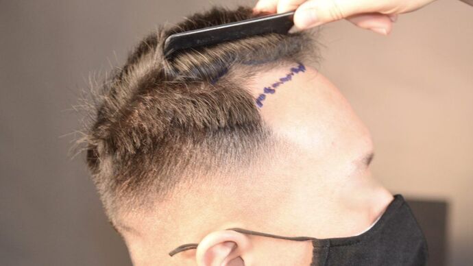 FUE Hair Restoration: Case 12 - Before