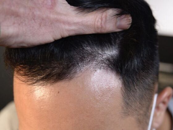 FUE Hair Restoration: Case 12 - After