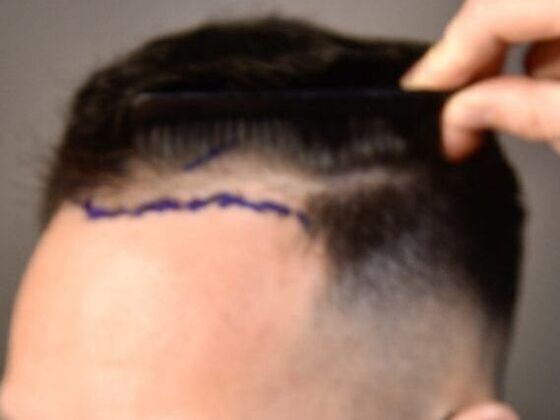 FUE Hair Restoration: Case 12 - Before